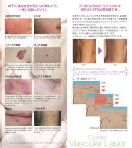 cutera_cascularlaser